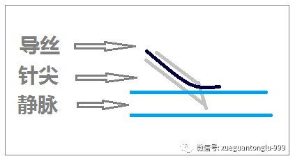 中心靜脈穿刺 三思而后行